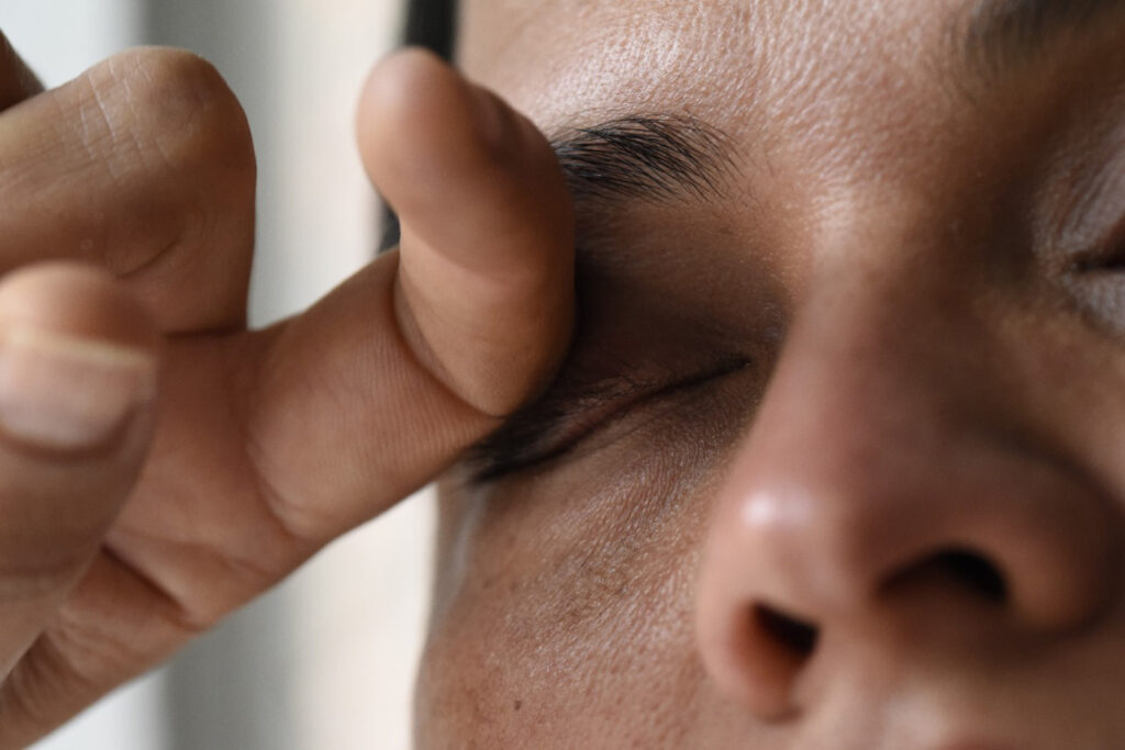 ¿Se rasca los ojos con frecuencia? Cuidado, puede desarrollar queratocono ¿Se rasca los ojos con frecuencia? Cuidado, puede desarrollar queratocono
