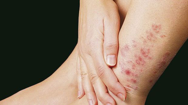 Conozca cómo actúa y cómo se debe prevenir la lepra Conozca cómo actúa y cómo se debe prevenir la lepra