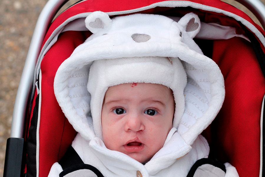 Labio y paladar fisurado: qué es y cómo tratarlo Labio y paladar fisurado: qué es y cómo tratarlo