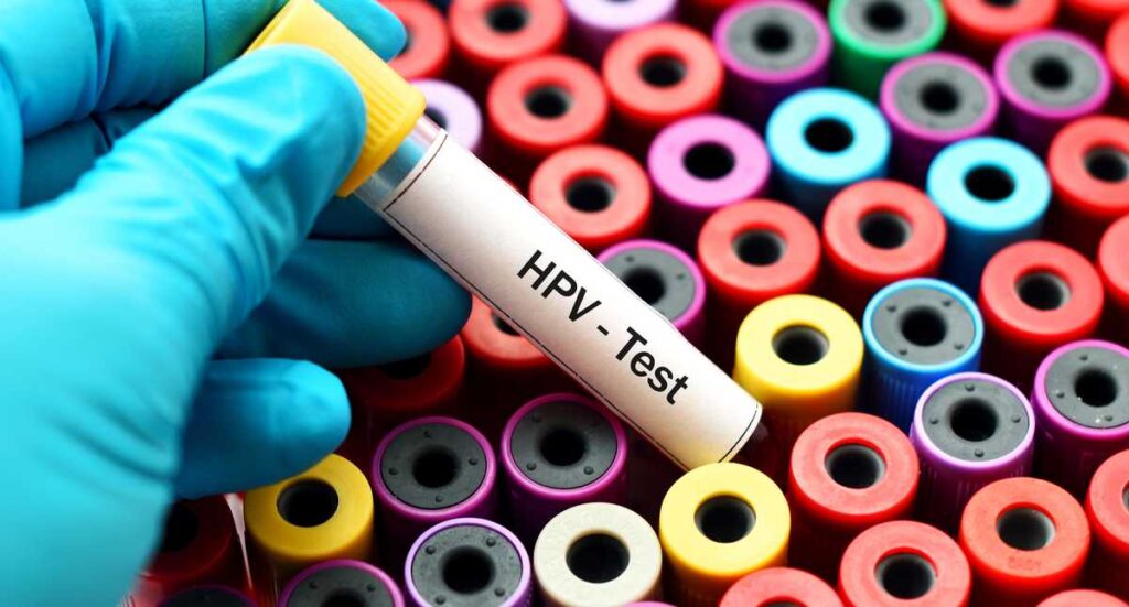 Prueba para detectar papiloma humano se debería hacer desde los 25 años Prueba para detectar papiloma humano se debería hacer desde los 25 años