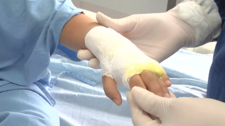 Quemados por pólvora en el Tolima se redujeron en un 31% Quemados por pólvora en el Tolima se redujeron en un 31%