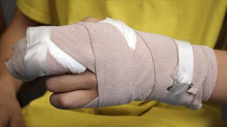 Aumenta a ocho el número de personas quemadas con pólvora en Ibagué Aumenta a ocho el número de personas quemadas con pólvora en Ibagué