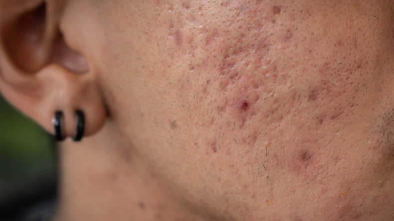 Sábila y caléndula, aliadas naturales contra el acné Sábila y caléndula, aliadas naturales contra el acné