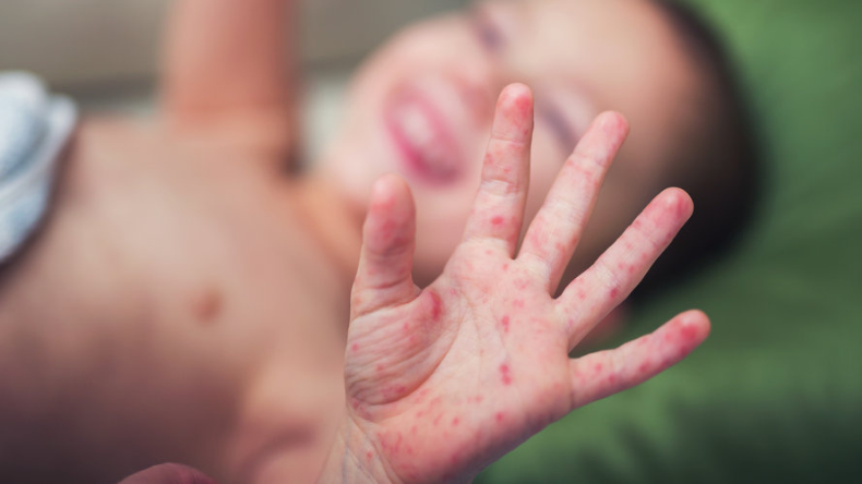 Síndrome mano-pie-boca: el virus que se propaga con rapidez en las guarderías