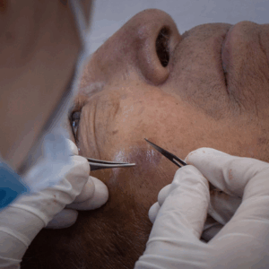 Ecografía dermatológica permite diagnósticos más precisos sin necesidad de biopsias