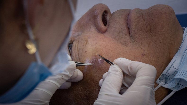 Ecografía dermatológica permite diagnósticos más precisos sin necesidad de biopsias Ecografía dermatológica permite diagnósticos más precisos sin necesidad de biopsias